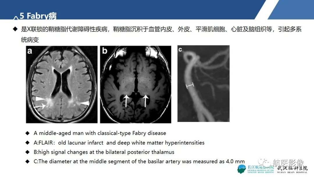 影像PPT - 【PPT】基底节区、丘脑对称性病变影像表现-21