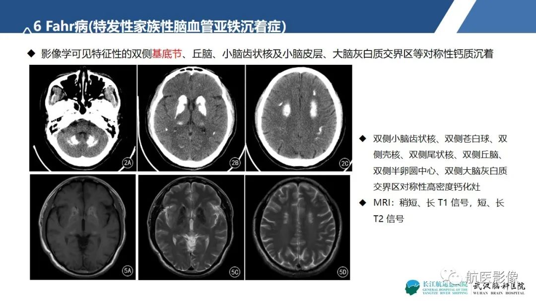 影像PPT - 【PPT】基底节区、丘脑对称性病变影像表现-22