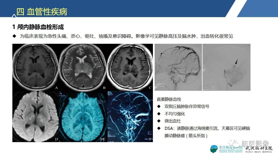 影像PPT - 【PPT】基底节区、丘脑对称性病变影像表现-23