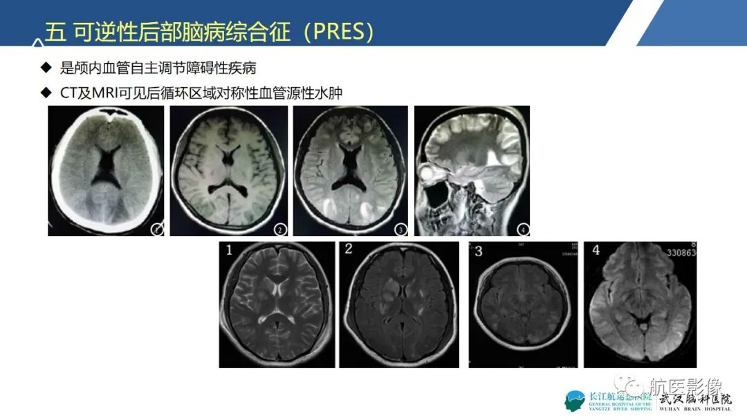 影像PPT - 【PPT】基底节区、丘脑对称性病变影像表现-26