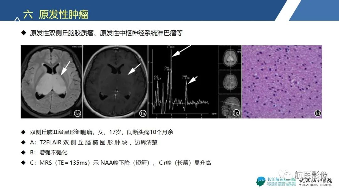 影像PPT - 【PPT】基底节区、丘脑对称性病变影像表现-27