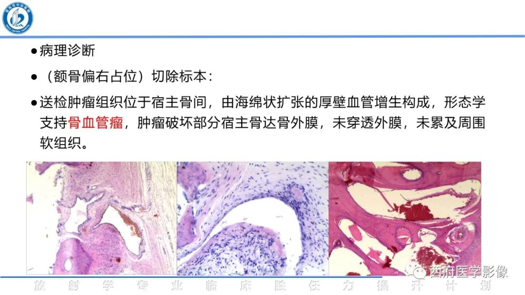 影像PPT - 【病例】颅骨血管瘤1例CT及MR影像诊断与鉴别-17