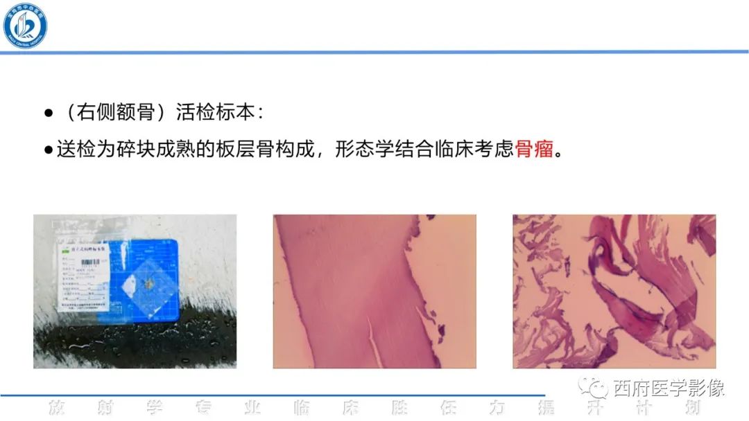 影像PPT - 【病例】颅骨血管瘤1例CT及MR影像诊断与鉴别-20