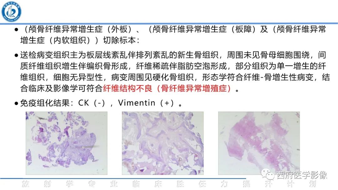 影像PPT - 【病例】颅骨血管瘤1例CT及MR影像诊断与鉴别-23