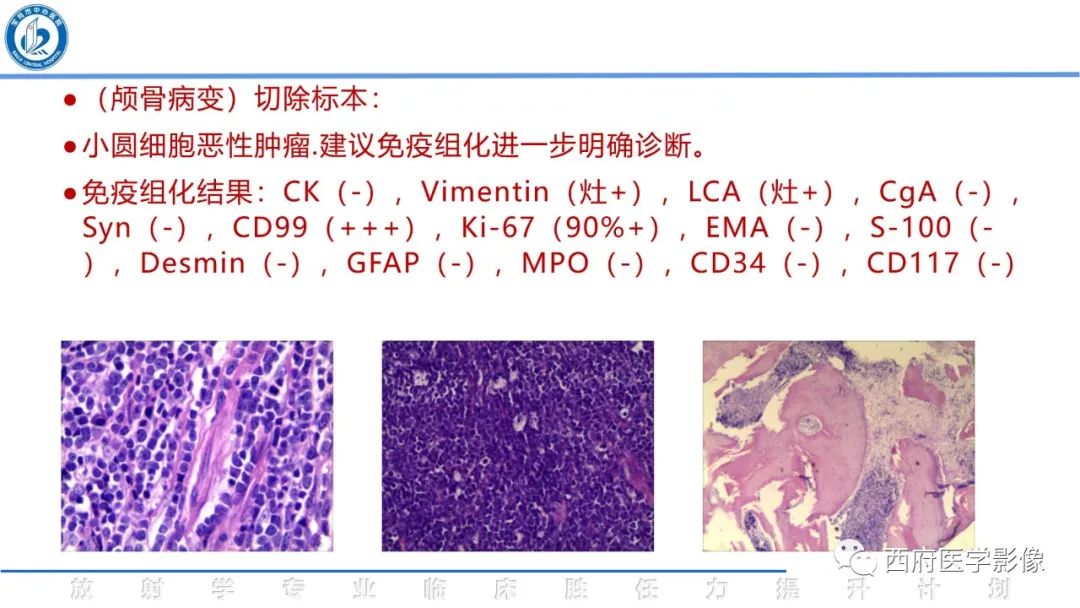 影像PPT - 【病例】颅骨血管瘤1例CT及MR影像诊断与鉴别-30