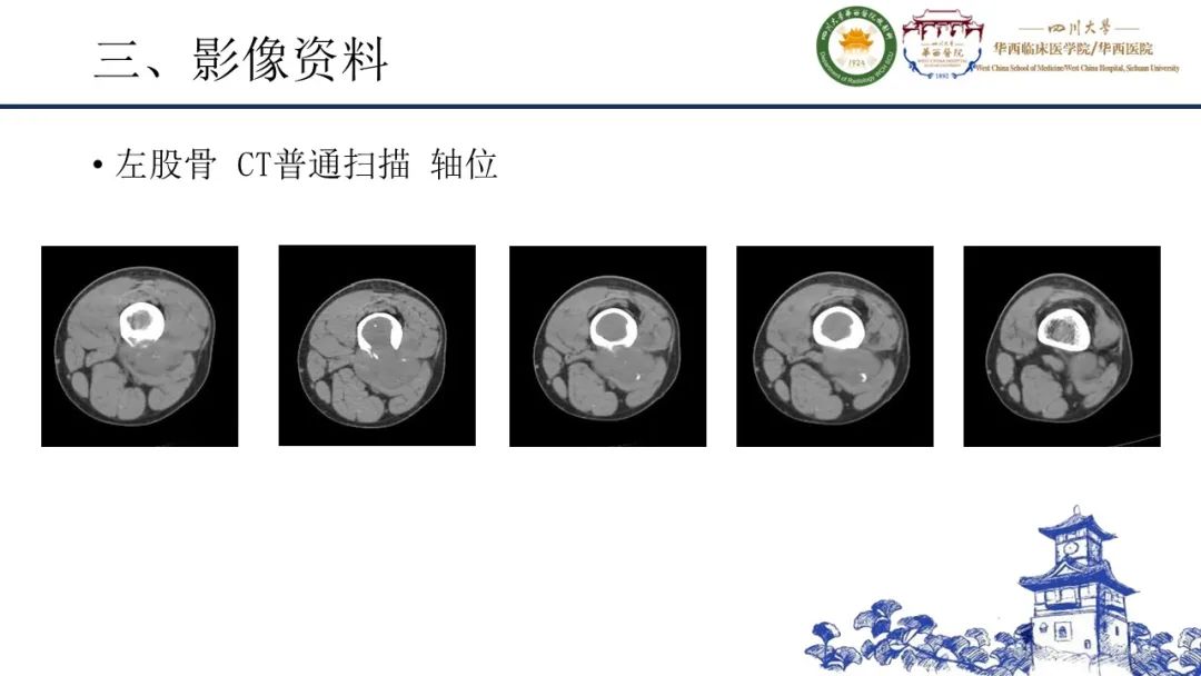 影像PPT - 【病例】黑色素性外周神经鞘膜肿瘤1例X线CT及MR影像-5