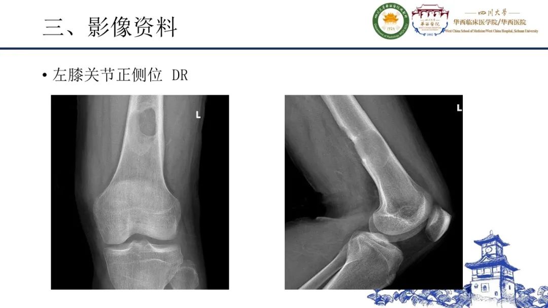 影像PPT - 【病例】黑色素性外周神经鞘膜肿瘤1例X线CT及MR影像-4