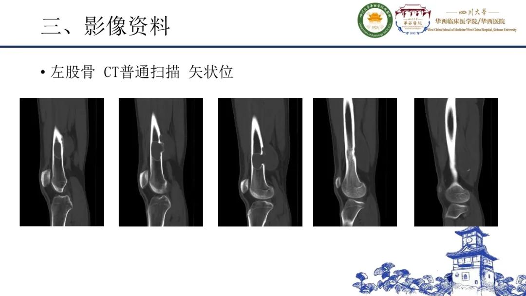 影像PPT - 【病例】黑色素性外周神经鞘膜肿瘤1例X线CT及MR影像-7