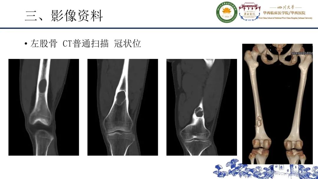 影像PPT - 【病例】黑色素性外周神经鞘膜肿瘤1例X线CT及MR影像-6