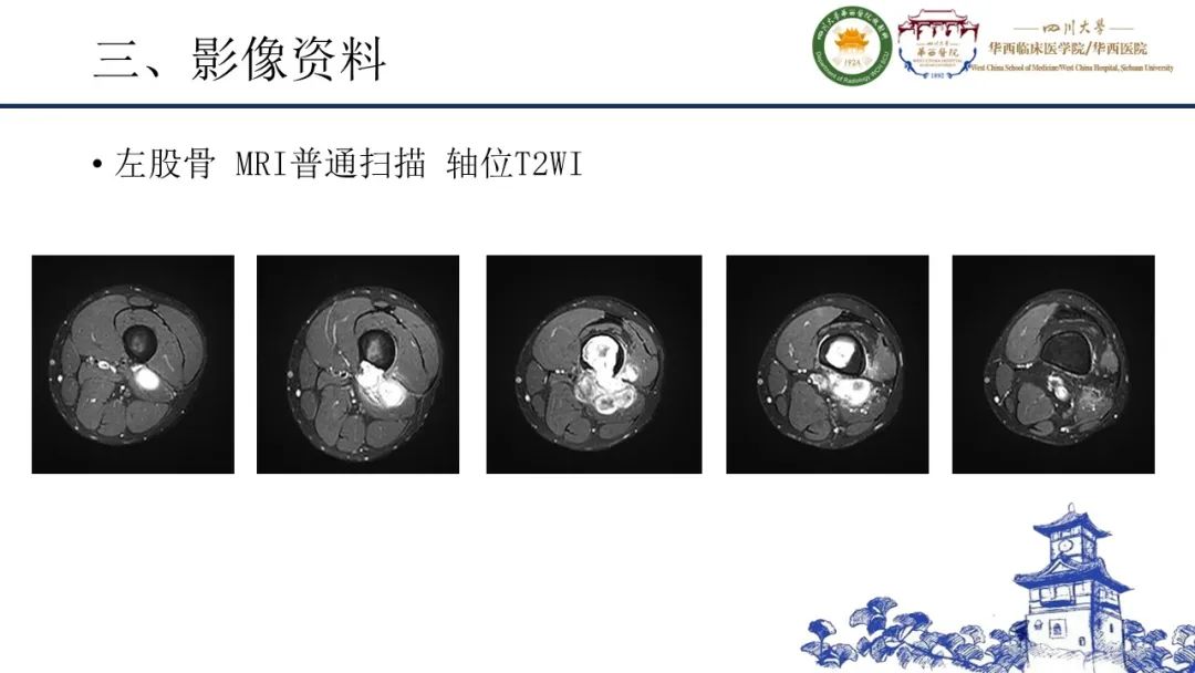 影像PPT - 【病例】黑色素性外周神经鞘膜肿瘤1例X线CT及MR影像-9
