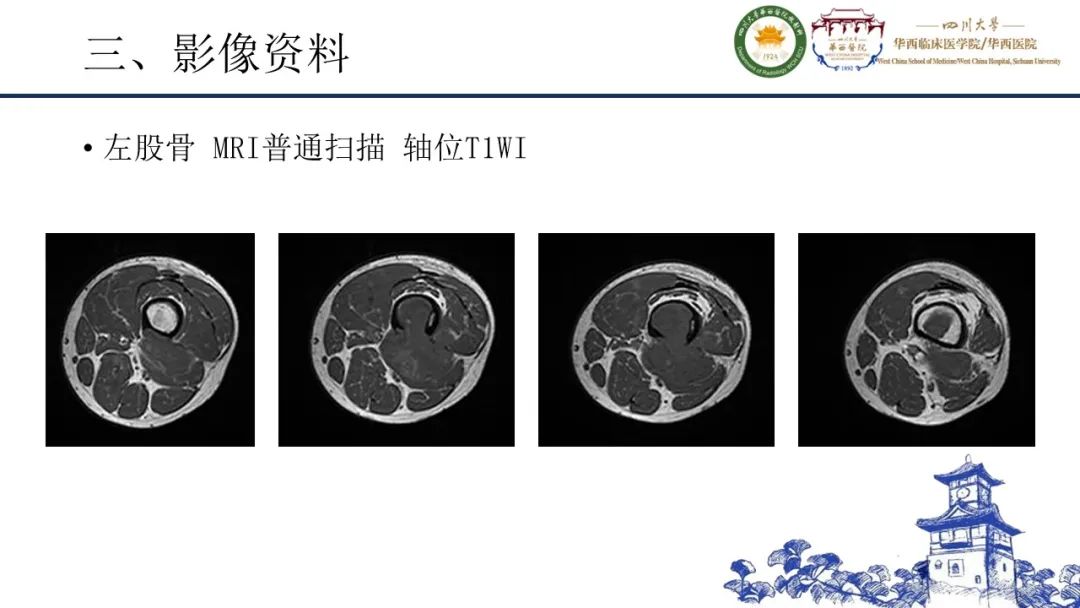 影像PPT - 【病例】黑色素性外周神经鞘膜肿瘤1例X线CT及MR影像-8