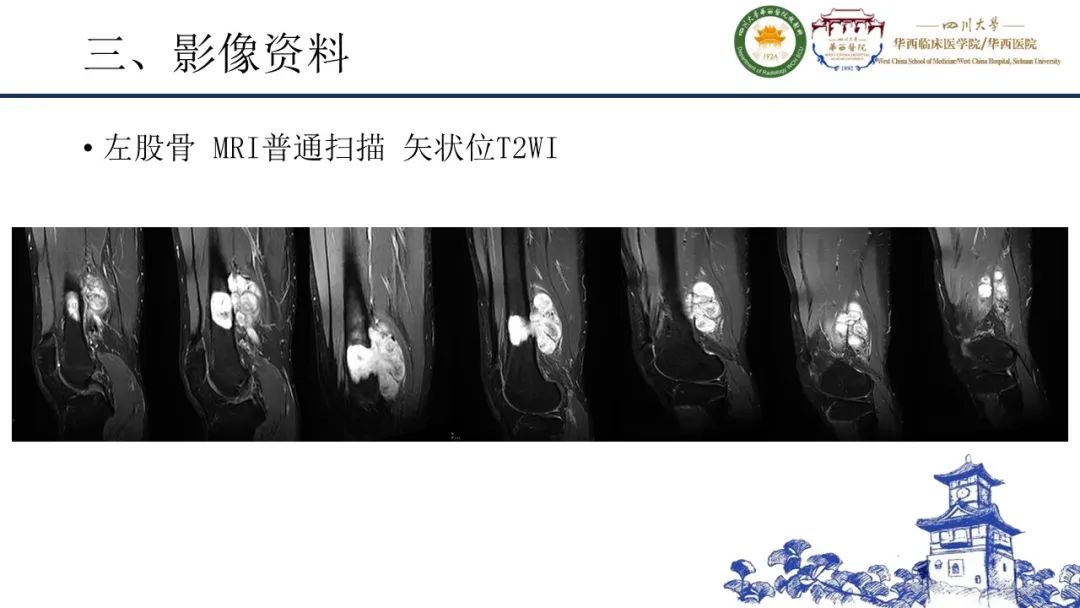 影像PPT - 【病例】黑色素性外周神经鞘膜肿瘤1例X线CT及MR影像-11