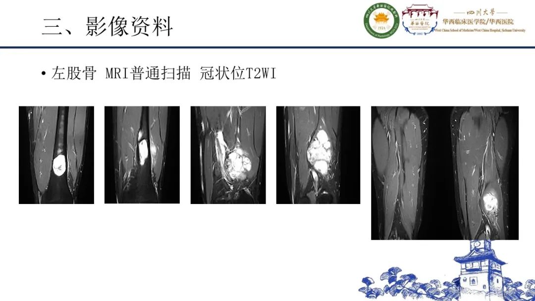 影像PPT - 【病例】黑色素性外周神经鞘膜肿瘤1例X线CT及MR影像-10
