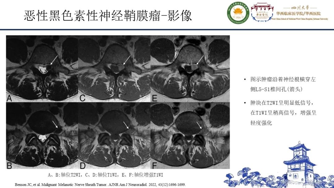 影像PPT - 【病例】黑色素性外周神经鞘膜肿瘤1例X线CT及MR影像-17