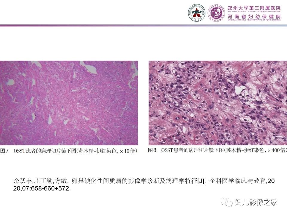 影像PPT - 【PPT】卵巢硬化性间质瘤-5