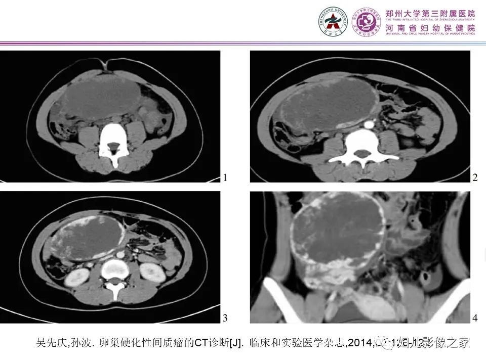 影像PPT - 【PPT】卵巢硬化性间质瘤-9