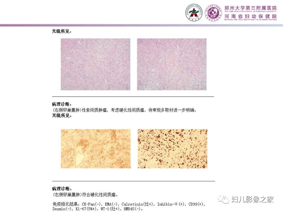 影像PPT - 【PPT】卵巢硬化性间质瘤-17