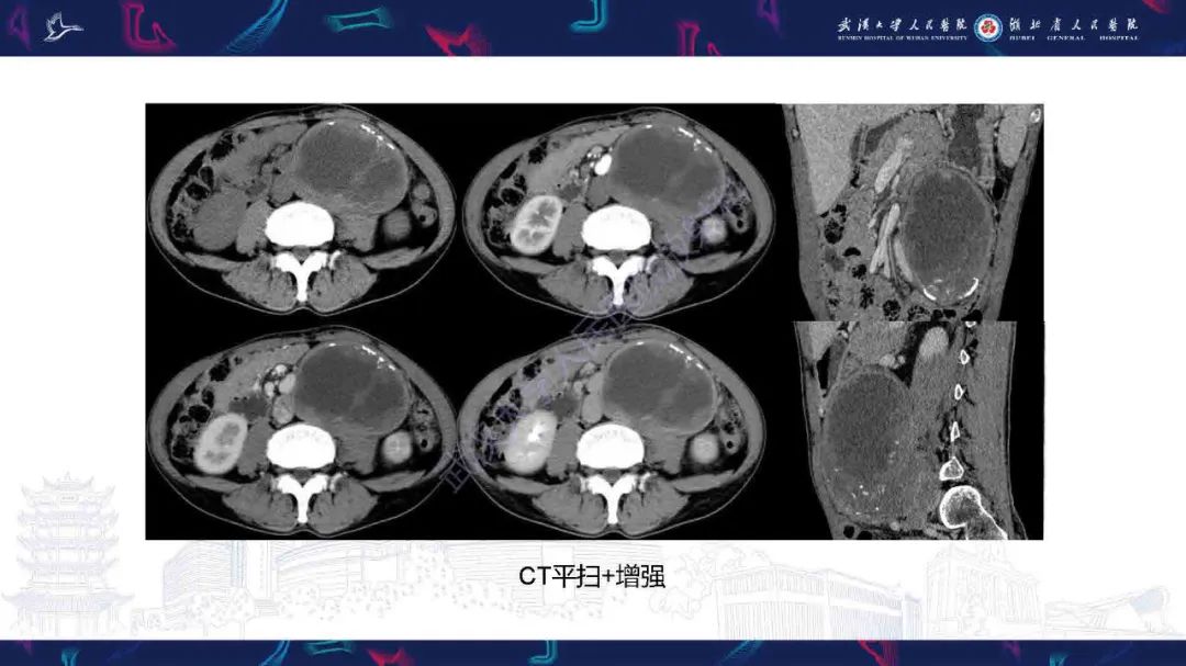 影像PPT - 【PPT】腹膜间皮瘤影像诊断-3