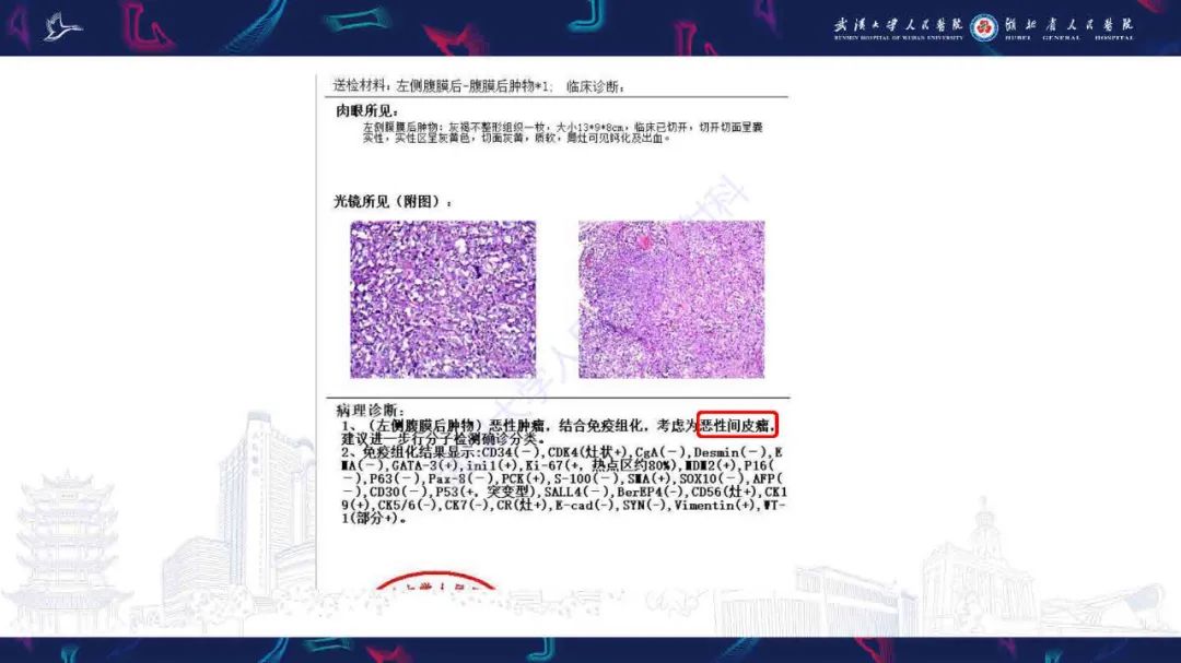影像PPT - 【PPT】腹膜间皮瘤影像诊断-5