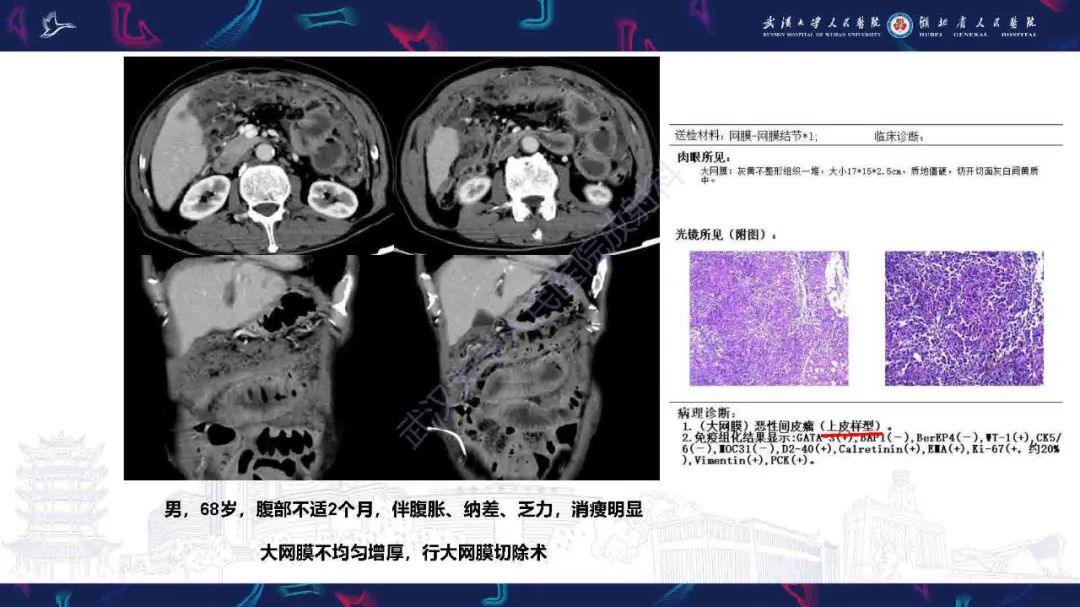 影像PPT - 【PPT】腹膜间皮瘤影像诊断-10