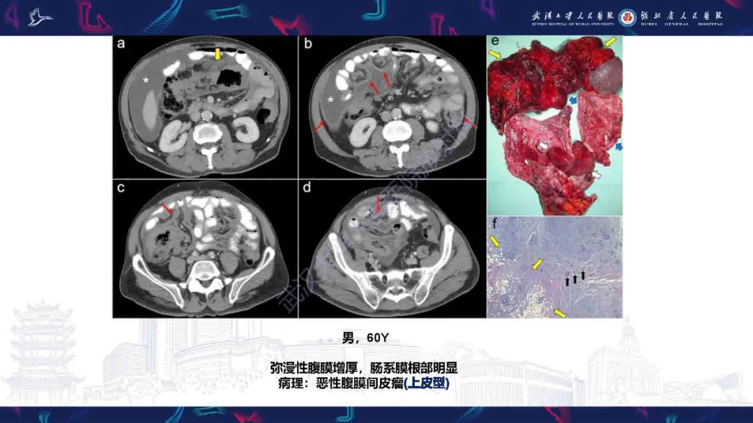 影像PPT - 【PPT】腹膜间皮瘤影像诊断-11