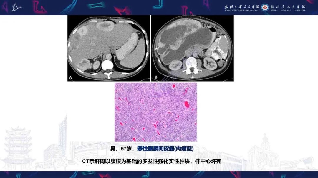 影像PPT - 【PPT】腹膜间皮瘤影像诊断-13