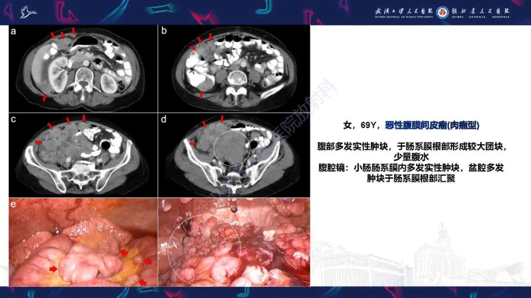 影像PPT - 【PPT】腹膜间皮瘤影像诊断-14