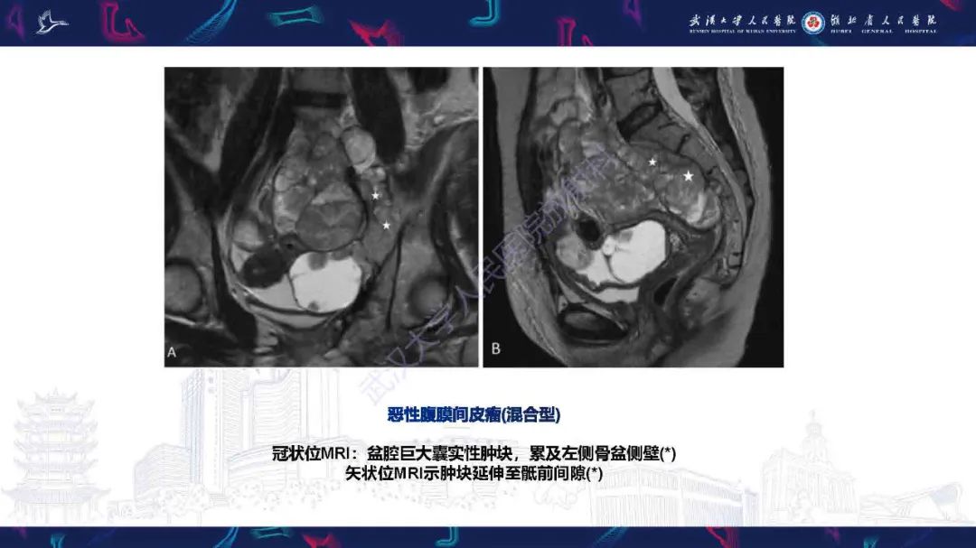 影像PPT - 【PPT】腹膜间皮瘤影像诊断-15
