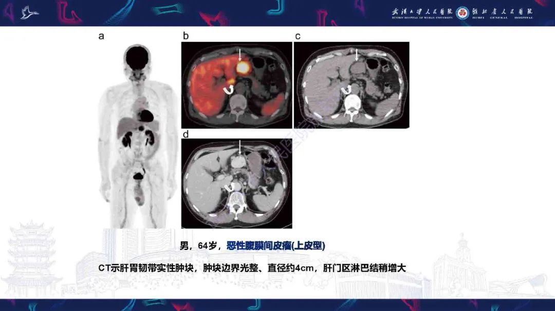 影像PPT - 【PPT】腹膜间皮瘤影像诊断-17