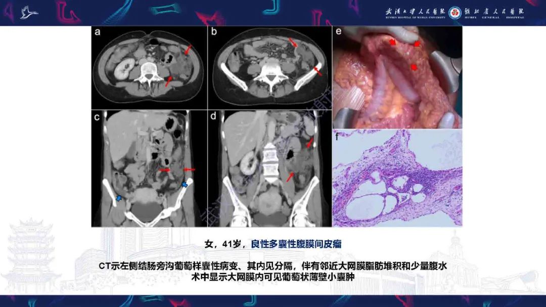 影像PPT - 【PPT】腹膜间皮瘤影像诊断-20