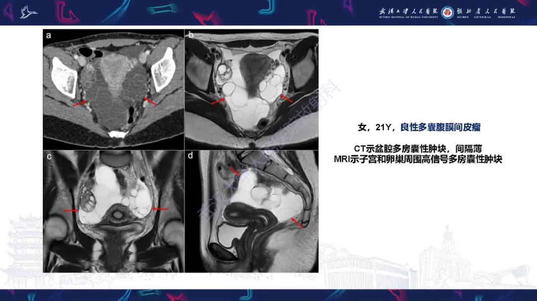 影像PPT - 【PPT】腹膜间皮瘤影像诊断-21