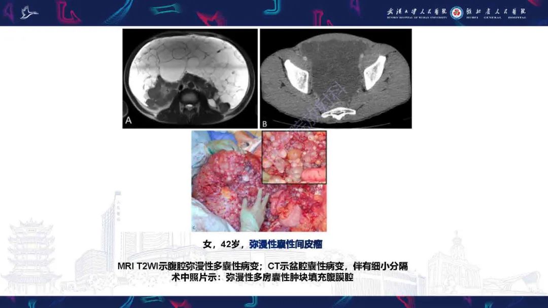 影像PPT - 【PPT】腹膜间皮瘤影像诊断-23