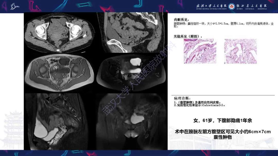 影像PPT - 【PPT】腹膜间皮瘤影像诊断-22