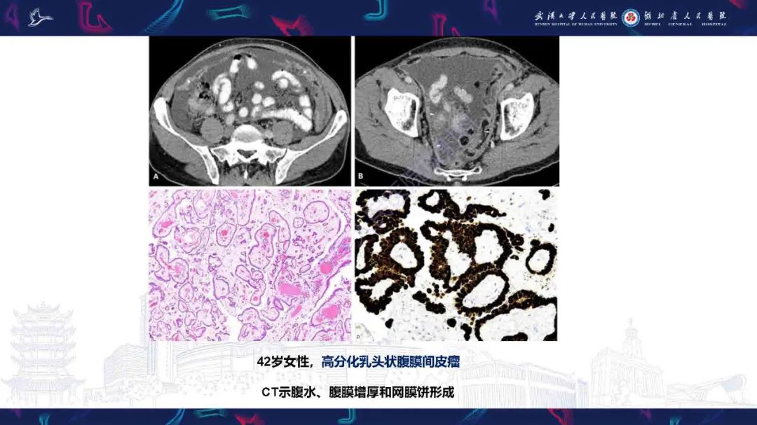 影像PPT - 【PPT】腹膜间皮瘤影像诊断-25