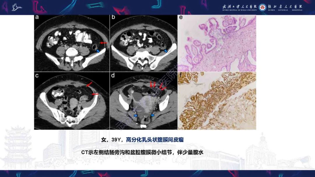 影像PPT - 【PPT】腹膜间皮瘤影像诊断-26
