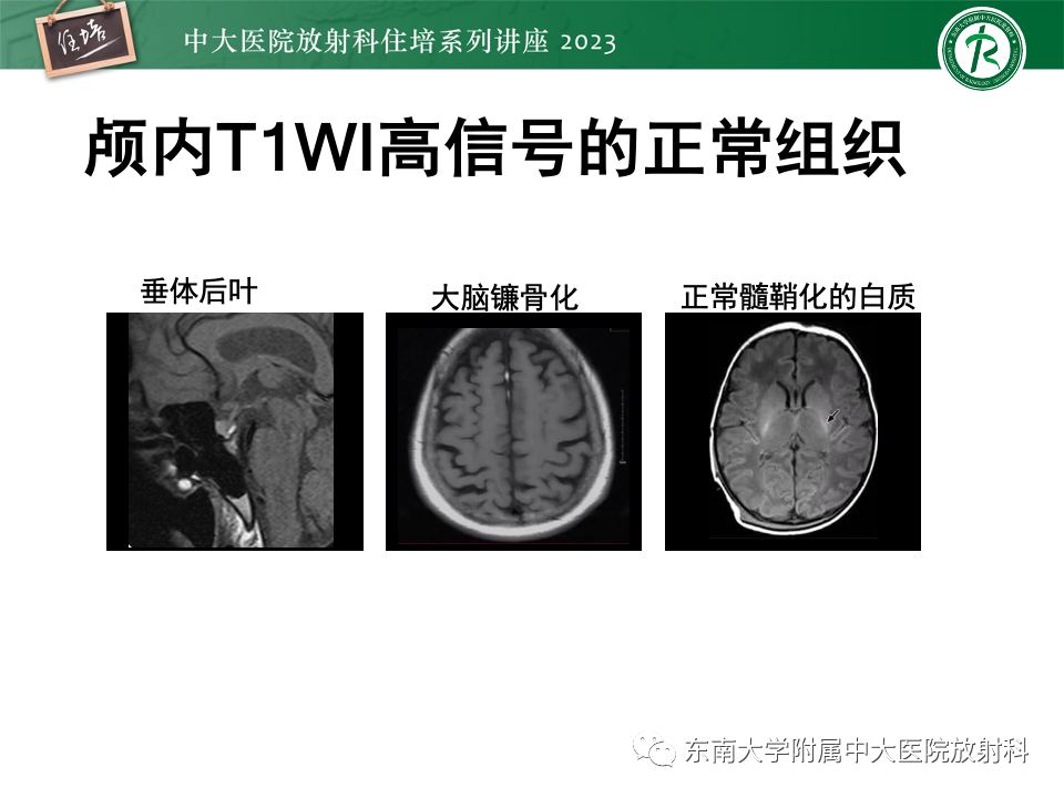 影像PPT - 【PPT】成人颅内T1WI高信号病变分析思路-3