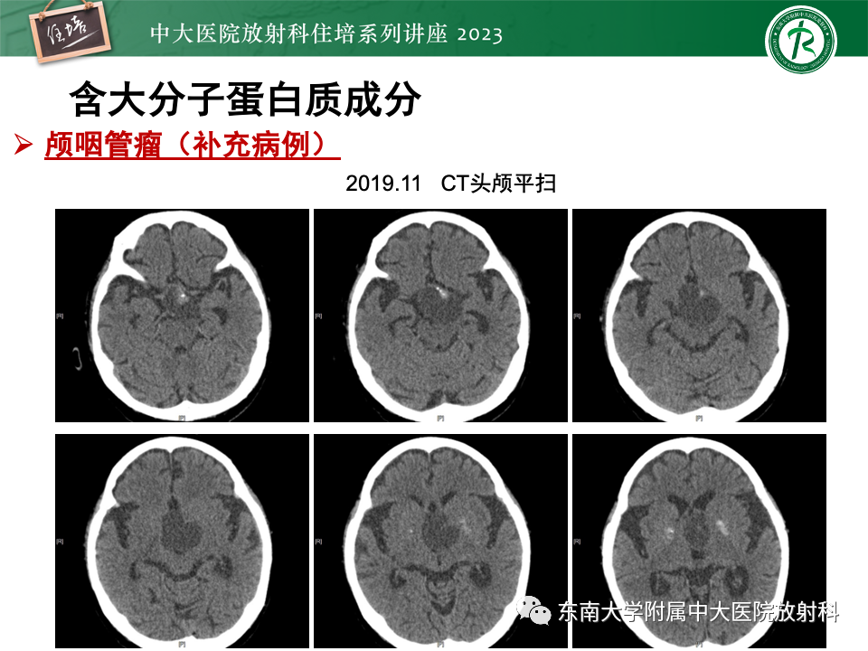 影像PPT - 【PPT】成人颅内T1WI高信号病变分析思路-15