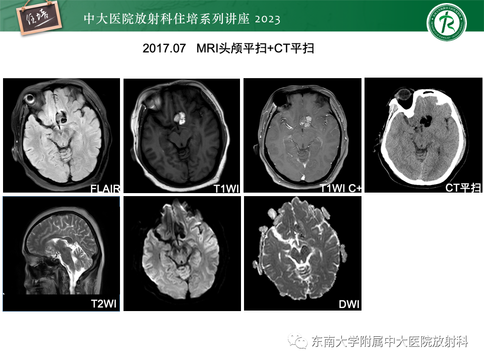 影像PPT - 【PPT】成人颅内T1WI高信号病变分析思路-24