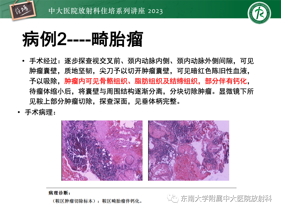 影像PPT - 【PPT】成人颅内T1WI高信号病变分析思路-25
