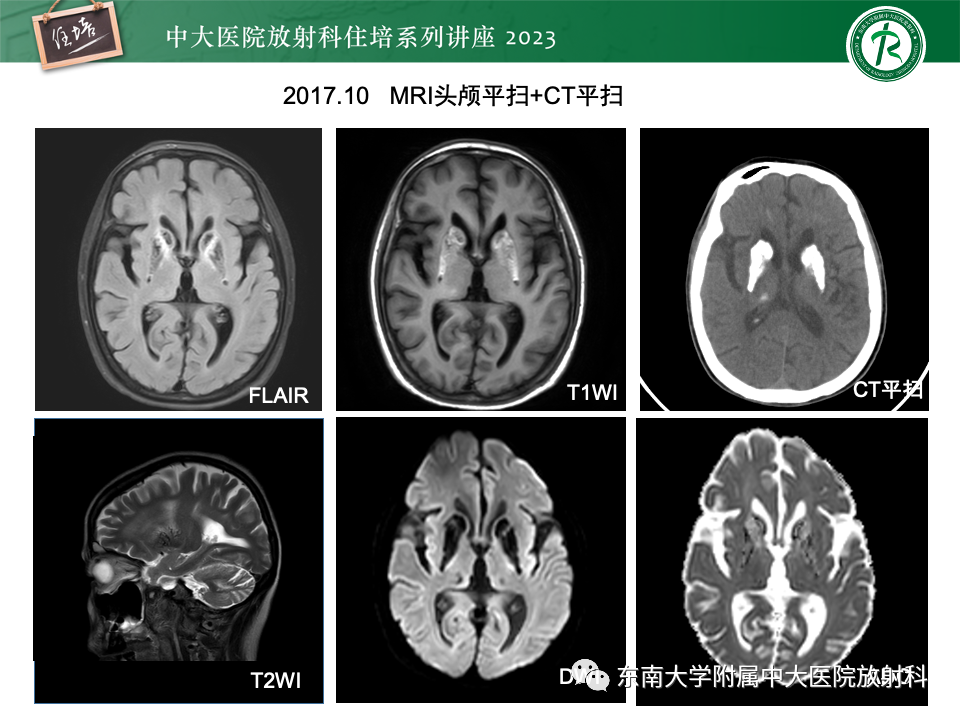 影像PPT - 【PPT】成人颅内T1WI高信号病变分析思路-33