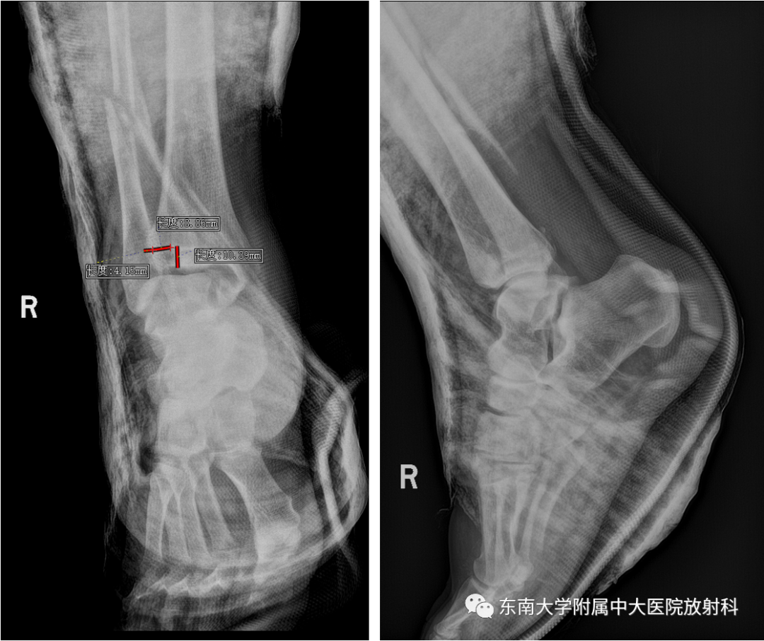 影像PPT - 【PPT】下胫腓联合分离损伤-1