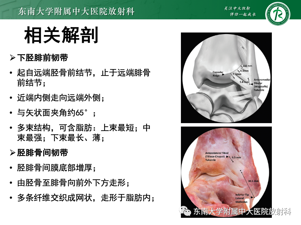 影像PPT - 【PPT】下胫腓联合分离损伤-6