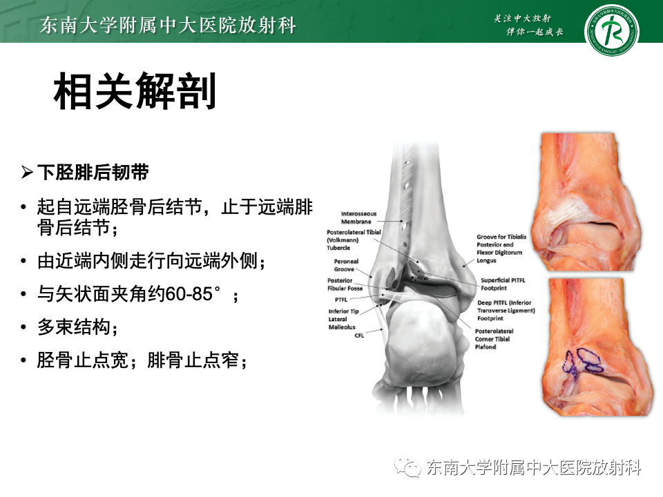 影像PPT - 【PPT】下胫腓联合分离损伤-7
