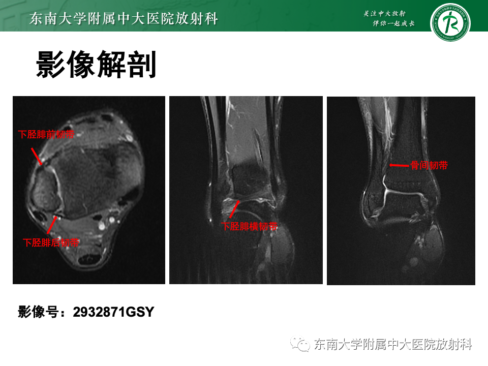 影像PPT - 【PPT】下胫腓联合分离损伤-9