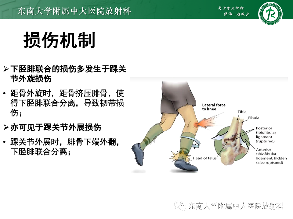 影像PPT - 【PPT】下胫腓联合分离损伤-11