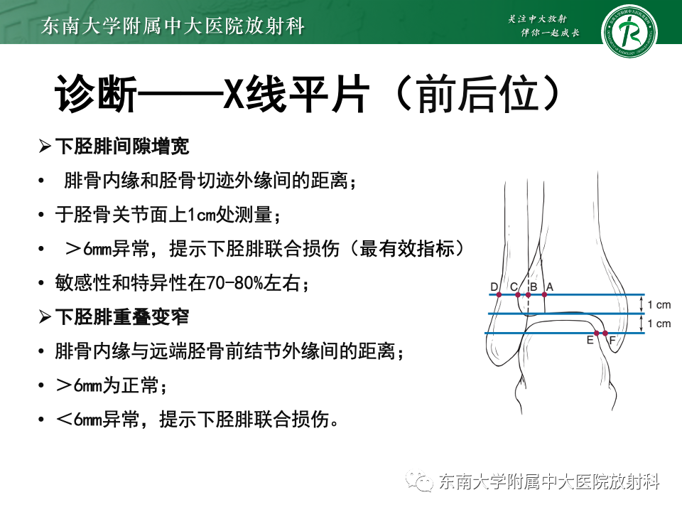 影像PPT - 【PPT】下胫腓联合分离损伤-14