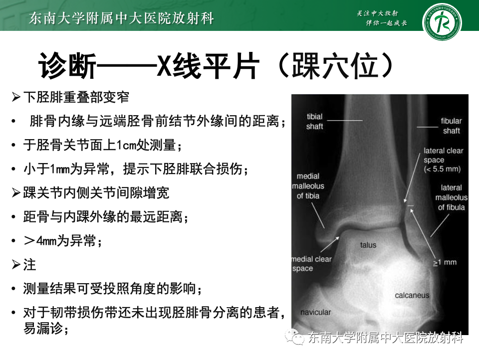 影像PPT - 【PPT】下胫腓联合分离损伤-15