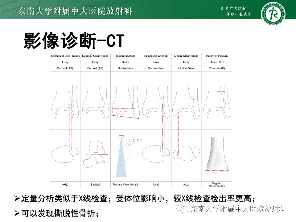 影像PPT - 【PPT】下胫腓联合分离损伤-16