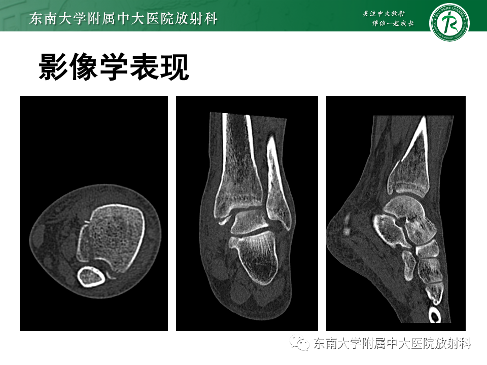 影像PPT - 【PPT】下胫腓联合分离损伤-18