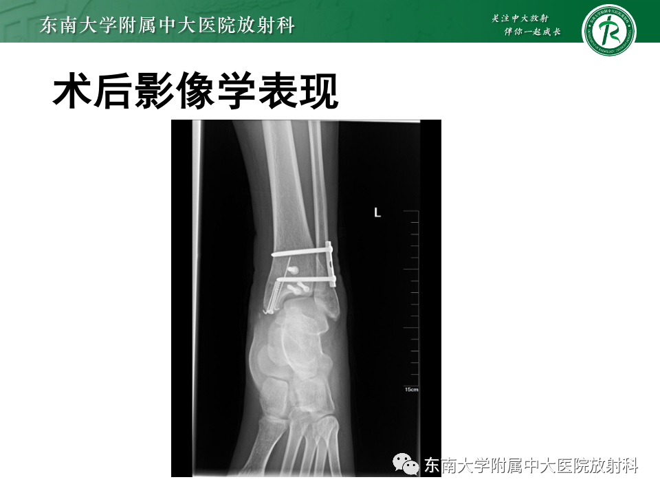 影像PPT - 【PPT】下胫腓联合分离损伤-21